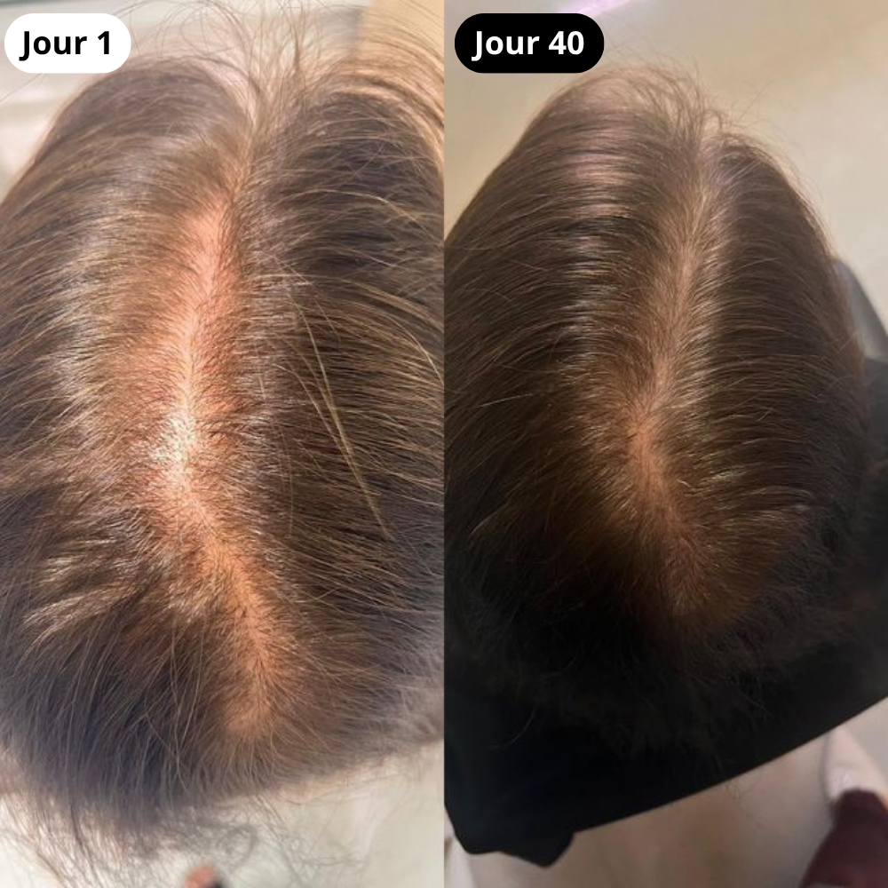 Brosse Stimulante Cuir Chevelu LED & Sérum